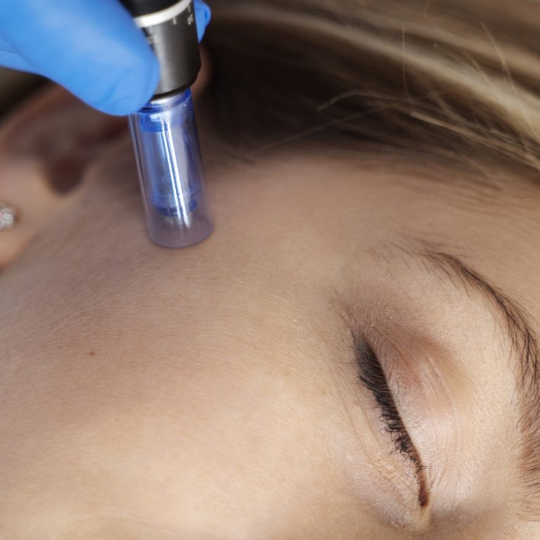 patient-undergoing-microneedling-procedure